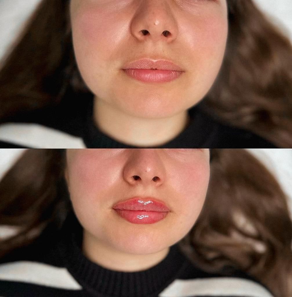 A before and after photo of a woman 's lips.