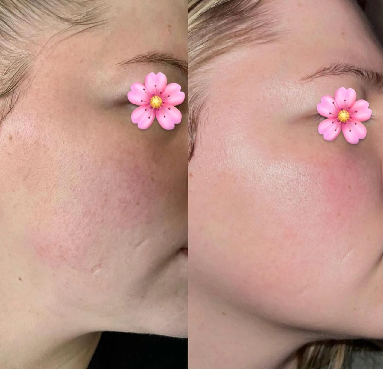 A before and after picture of a woman 's face with a pink flower on her eye.