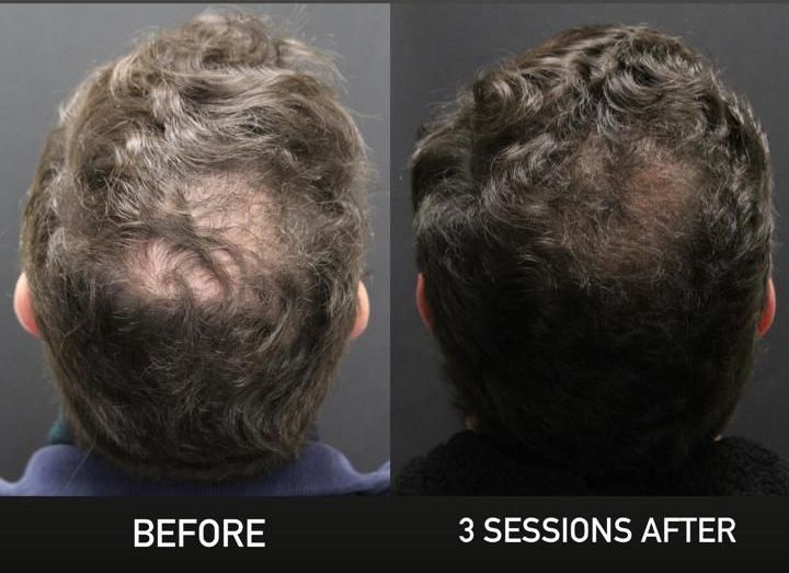 A before and after photo of a person 's hair with alma ted written on the bottom