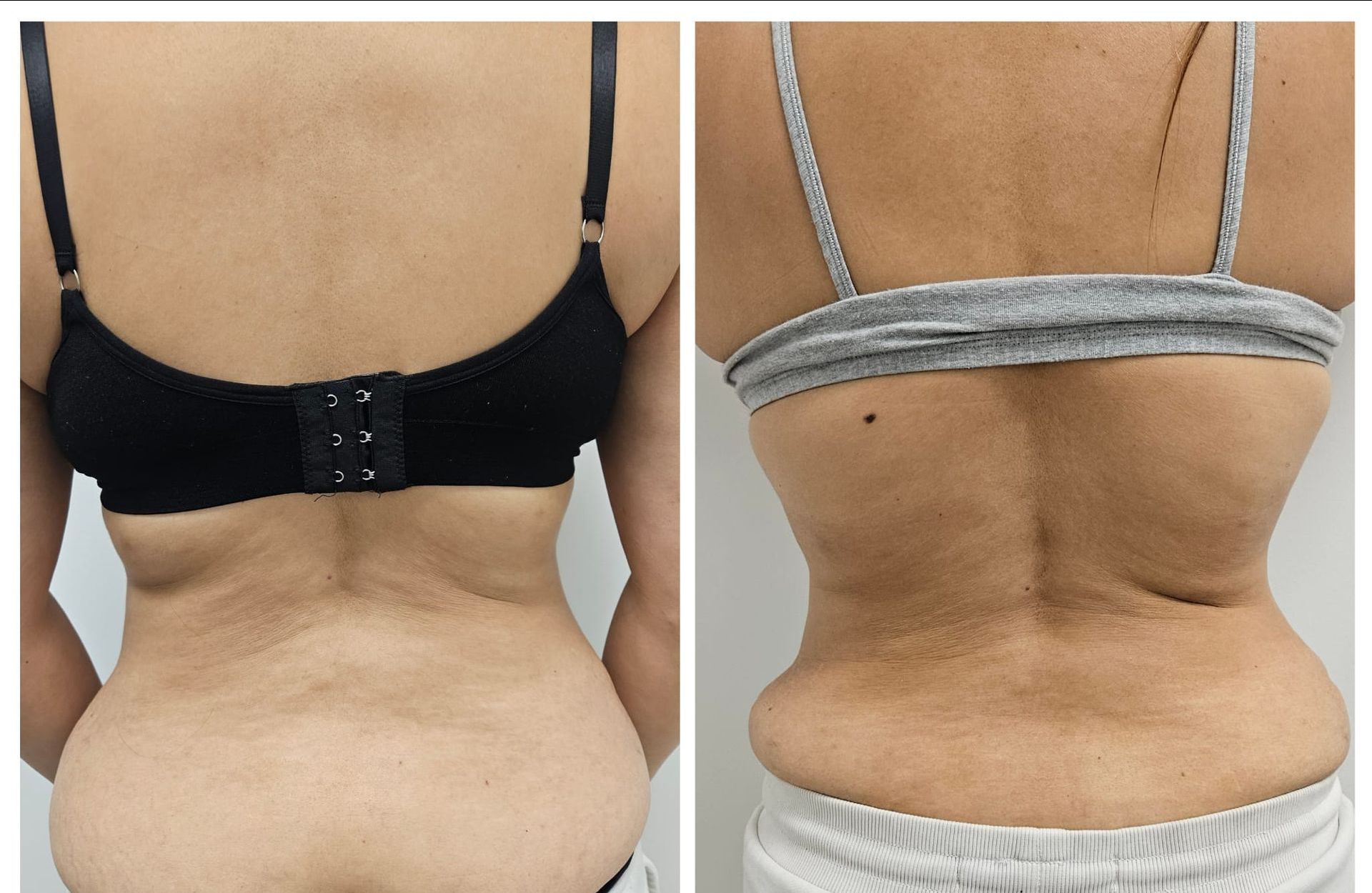 A before and after photo of a woman 's back in a bra.