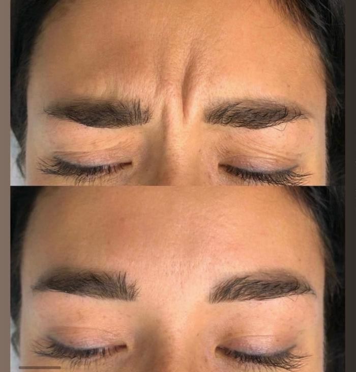 A before and after photo of a woman 's forehead with her eyes closed.