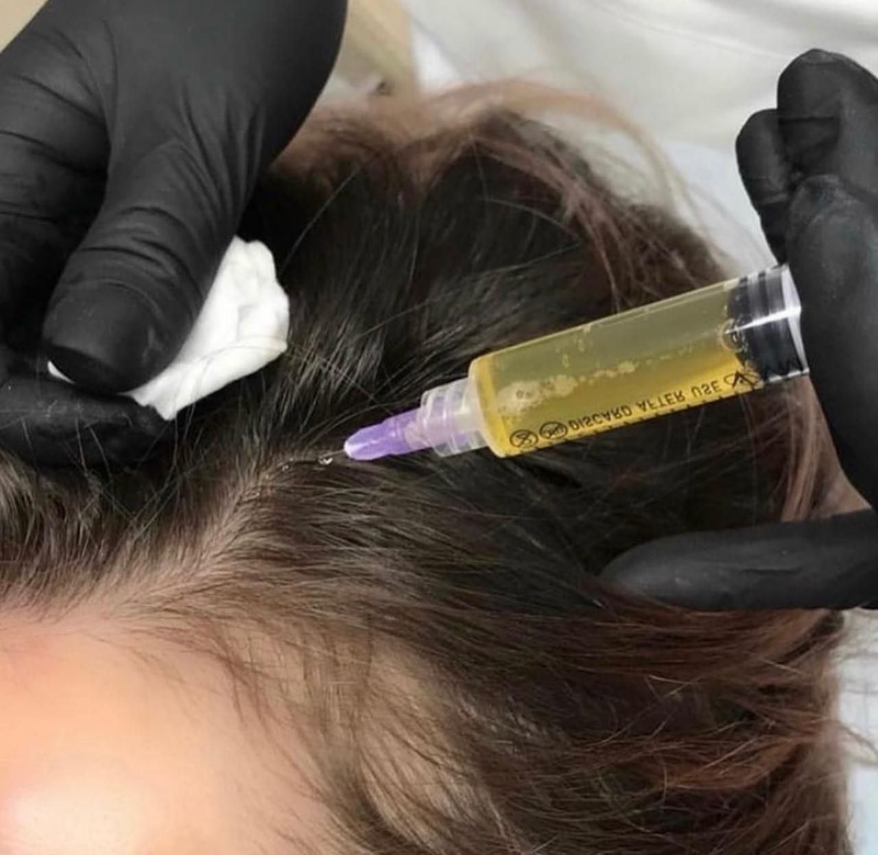 Gloved hands injecting a syringe filled with yellow liquid into a person's scalp, near a part in the hair.