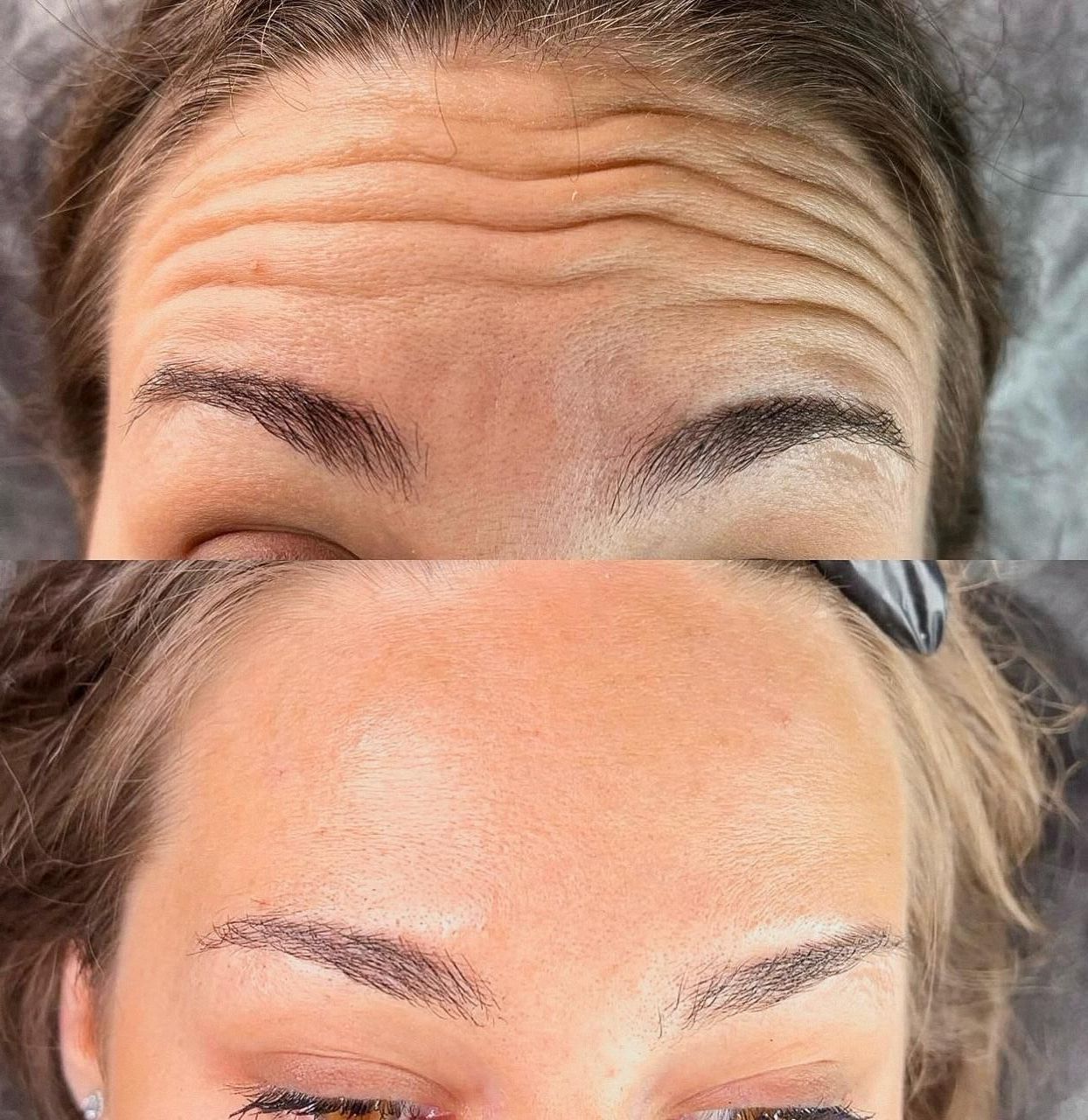 A woman 's forehead before and after botox treatment.