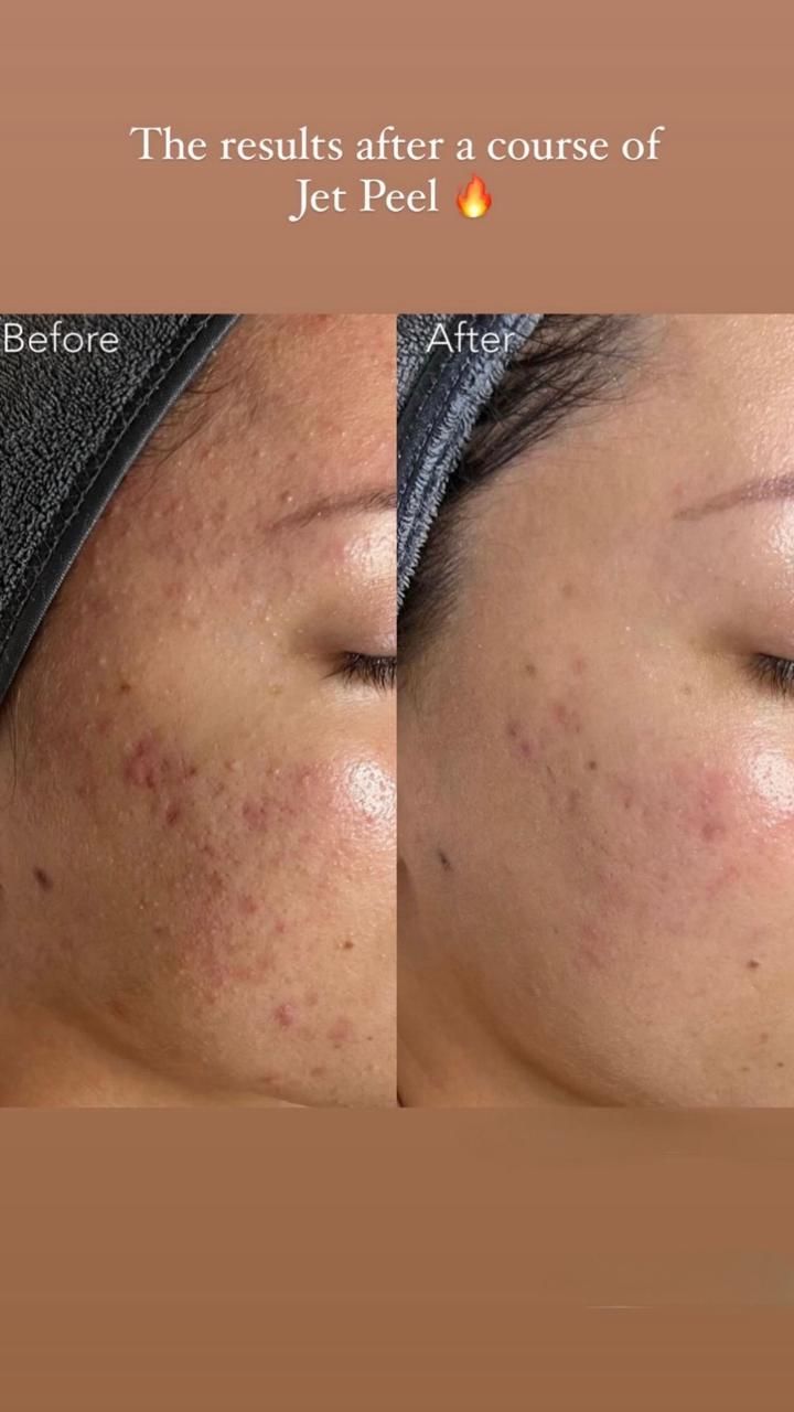 A woman 's face before and after a course of jet peel.