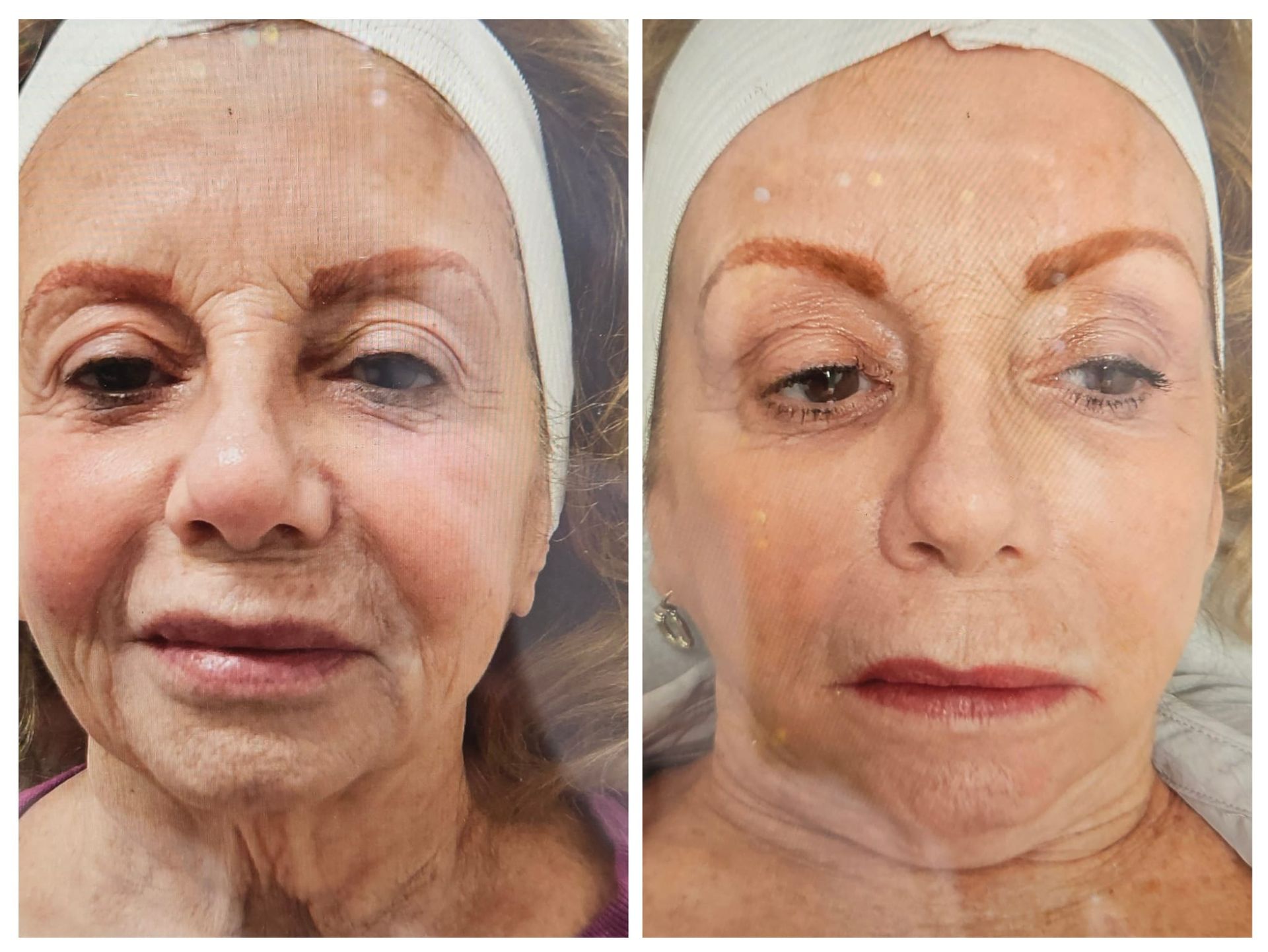 A before and after photo of an older woman 's face.