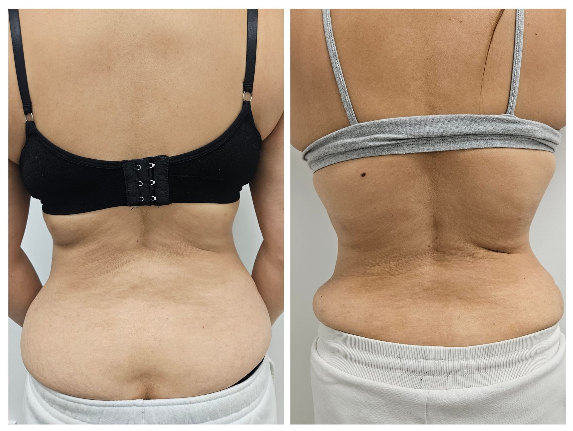 A before and after photo of a woman 's back in a bra.