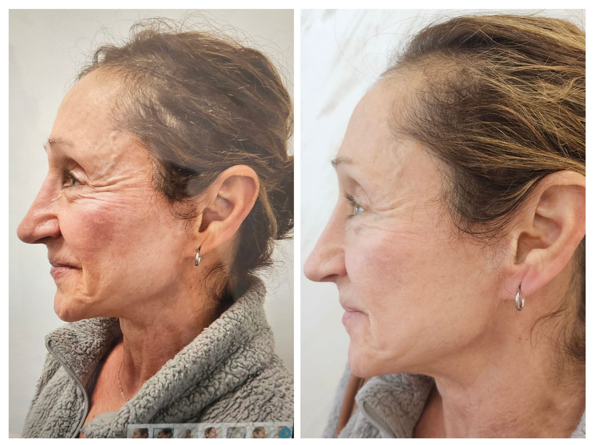 A before and after photo of a woman 's face.