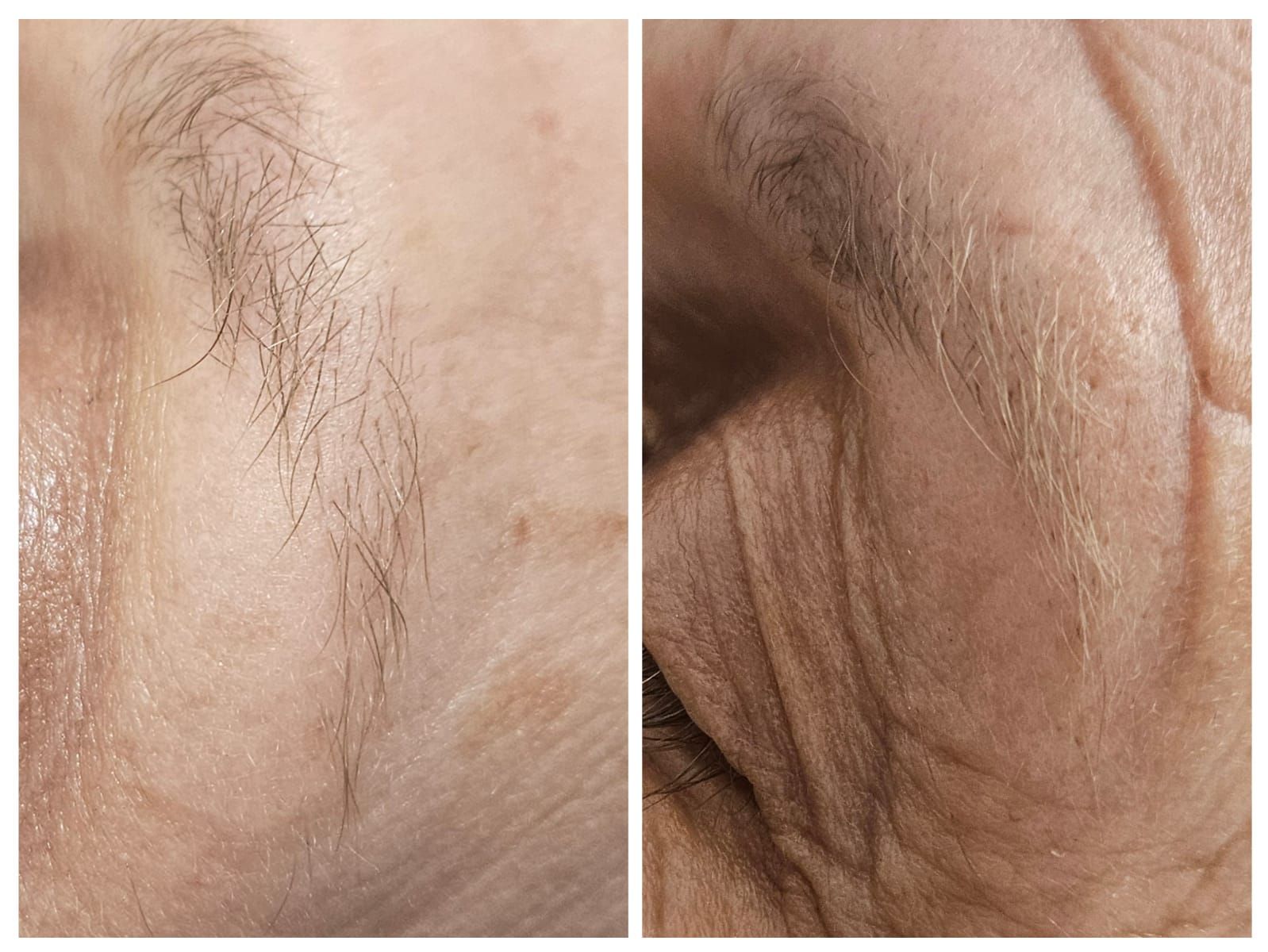 A before and after photo of a woman 's face with hair on it.