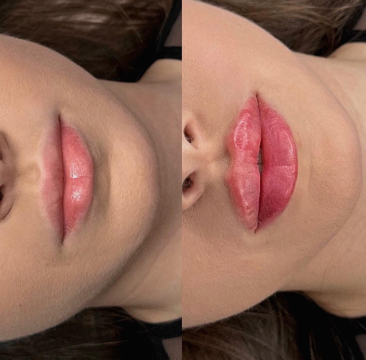 A before and after picture of a woman 's lips.