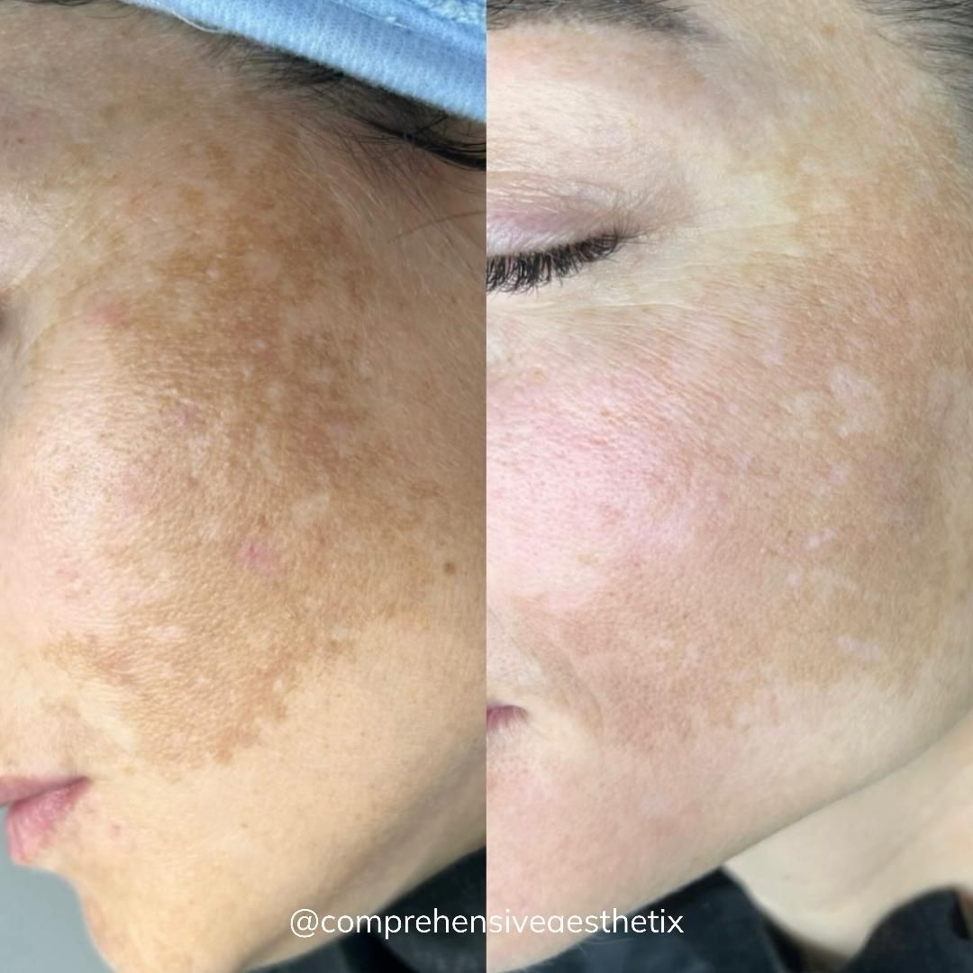 A woman 's face is shown before and after a treatment.