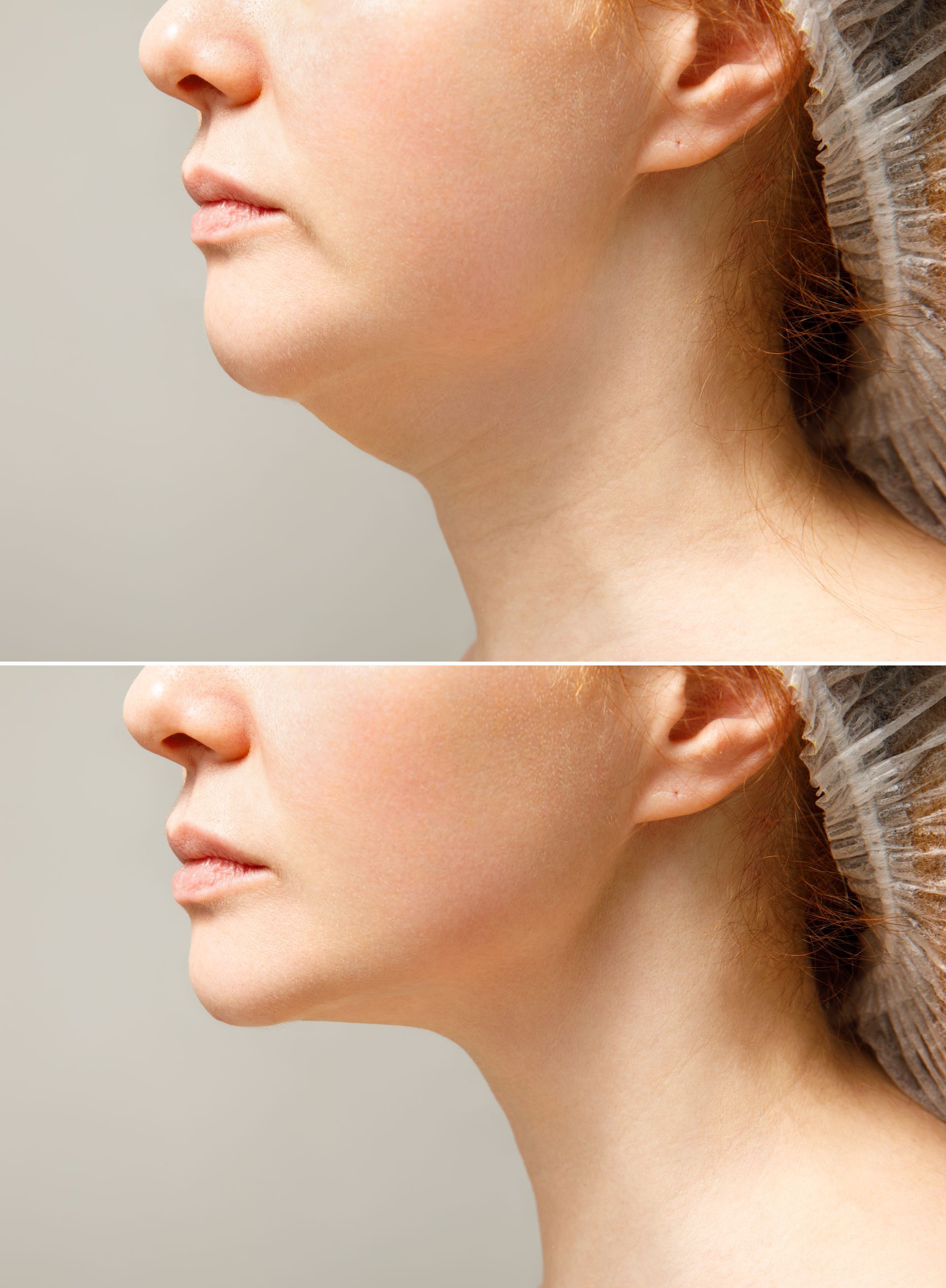 A before and after photo of a woman 's neck and chin.