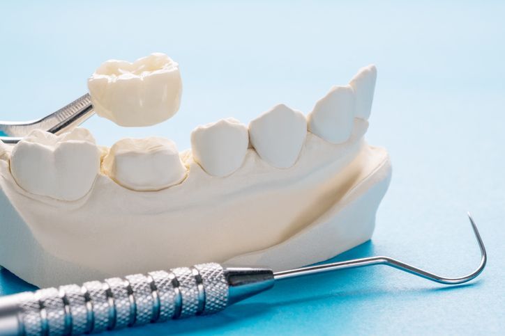 A model of a person 's teeth with a dental crown and a dental probe.