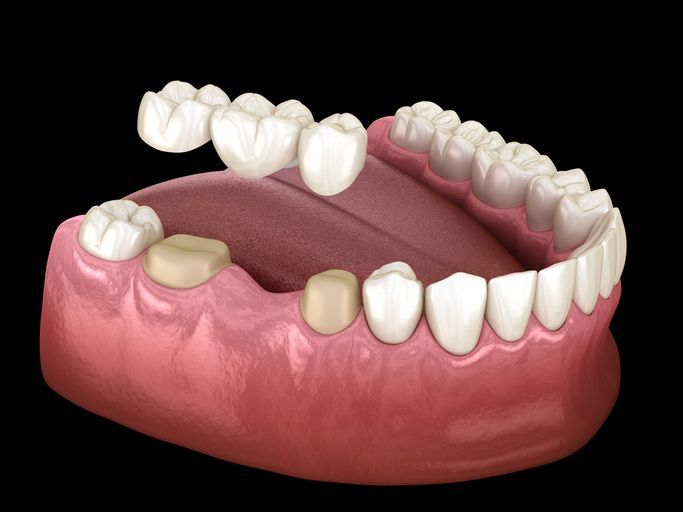 A computer generated image of a dental bridge in a mouth.