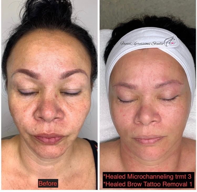 A before and after photo of a woman 's face.