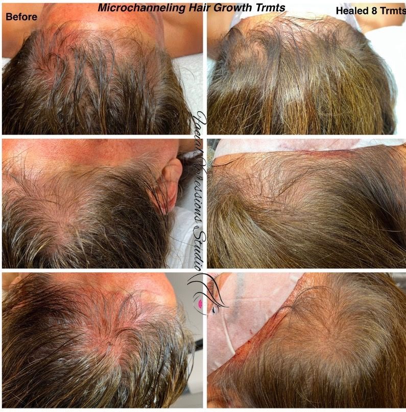 A before and after photo of a hair growth treatment