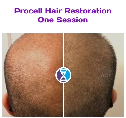 A picture of a man 's head before and after procell hair restoration