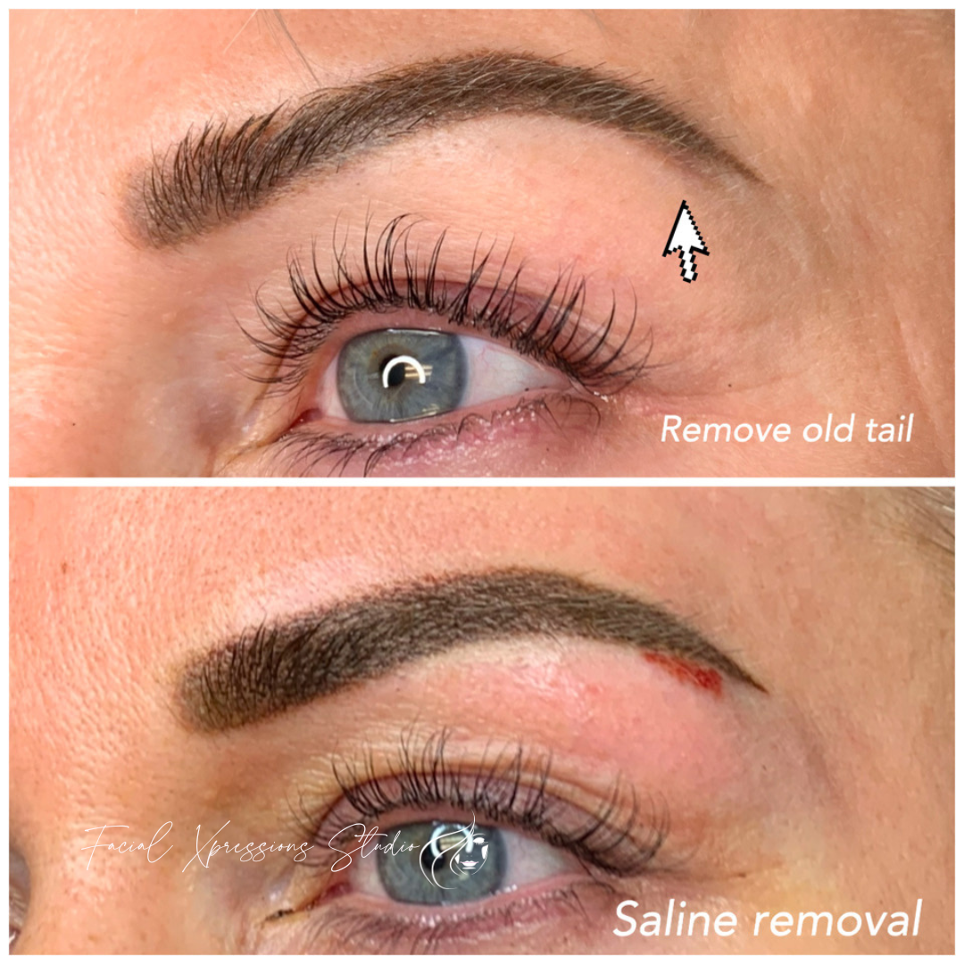 A before and after photo of a woman 's eye with saline removal.