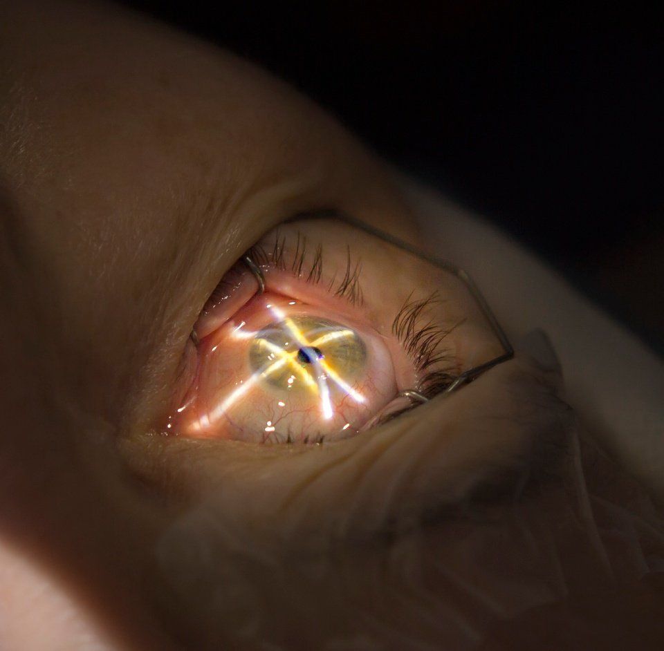 Laser per chirurgia refrattiva
