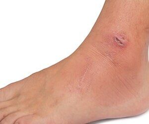 Wound on foot — Podiatry problems in Tampa, FL