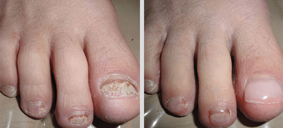 Before and After Nail Care - North Tampa Foot Care in Tampa, FL