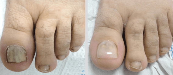 Before and After Nail Restoration - North Tampa Foot Care in Tampa, FL