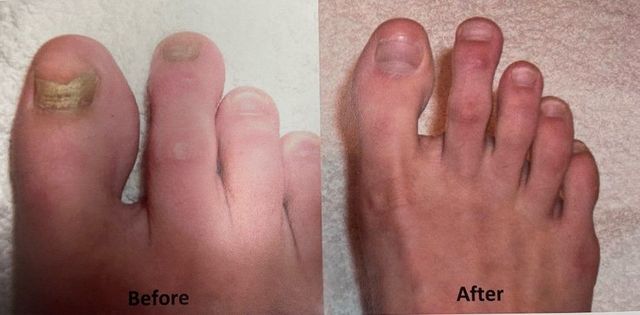 Fungal Nail Infections | Onychomycosis | Specialized Clinics