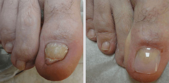 Before and After Nail Cosmetic - North Tampa Foot Care in Tampa, FL