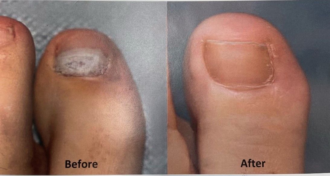 Before and After Pinky Foot Finger - Tampa, FL - North Tampa Foot Care