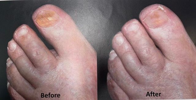 OUHOE Nail Fungal Treatment Serum Anti Infection Toe Fungus Repair Liq –  jaynehoe