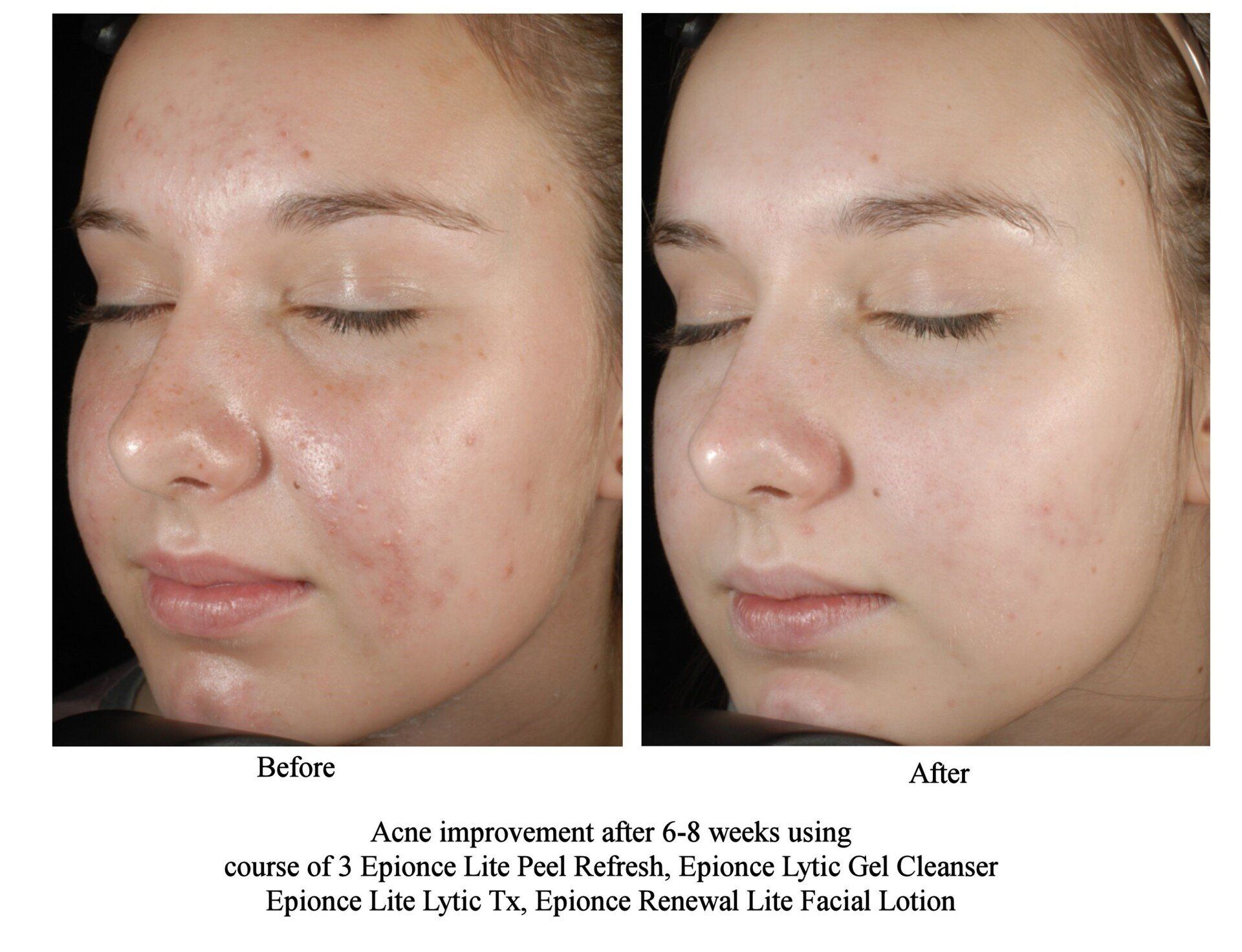 before and after a face peel