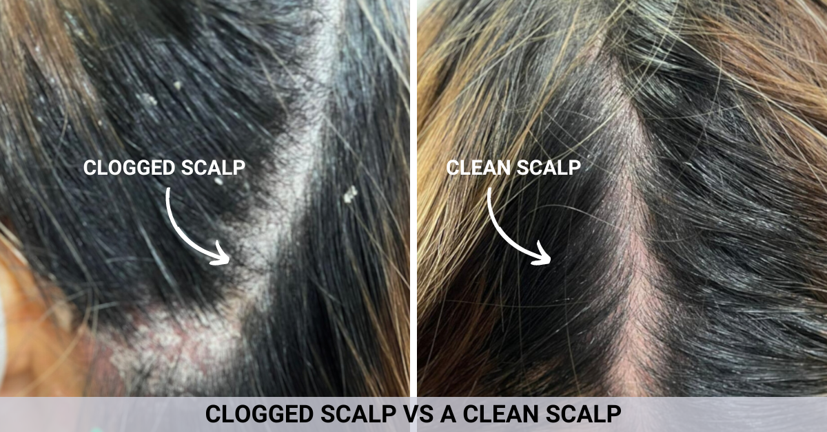 An image of a  Scalp Treatment before and after at Kimage