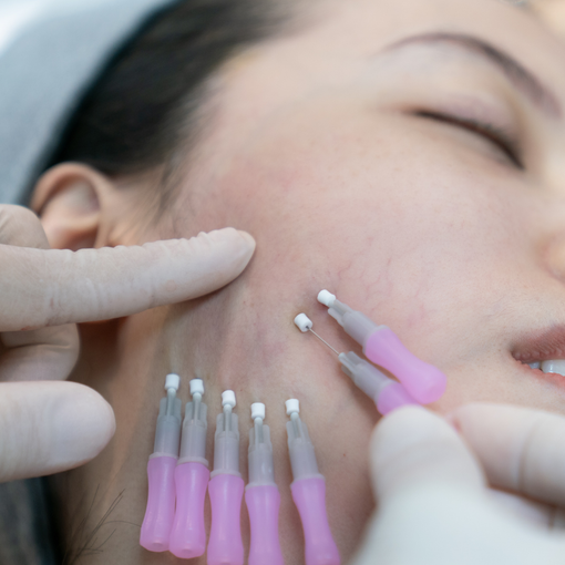 A woman undergoing a thread lift procedure. Needles with pink handles are being inserted into her cheek.
