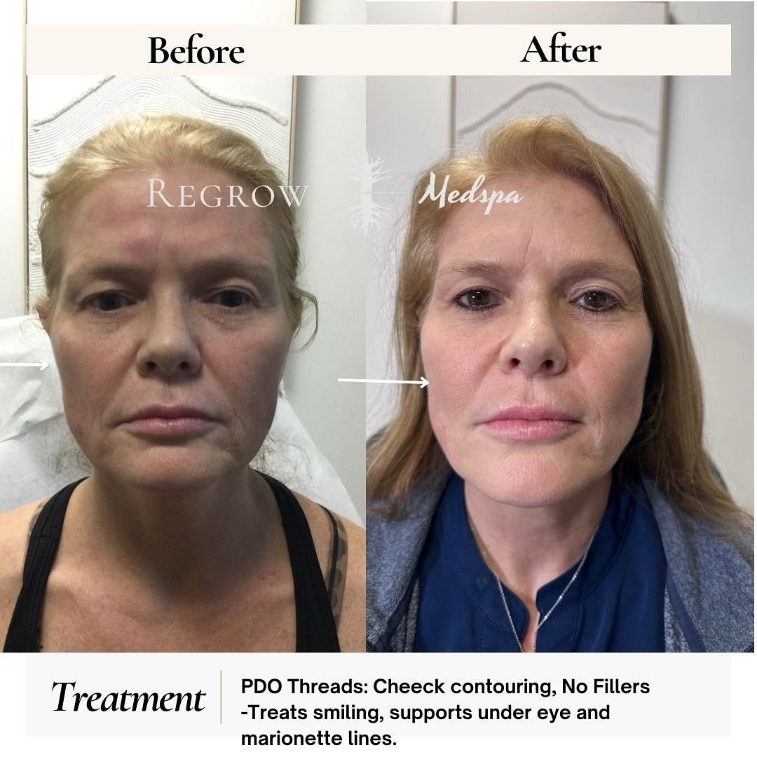 Before/After photo comparison of a woman's face. The 