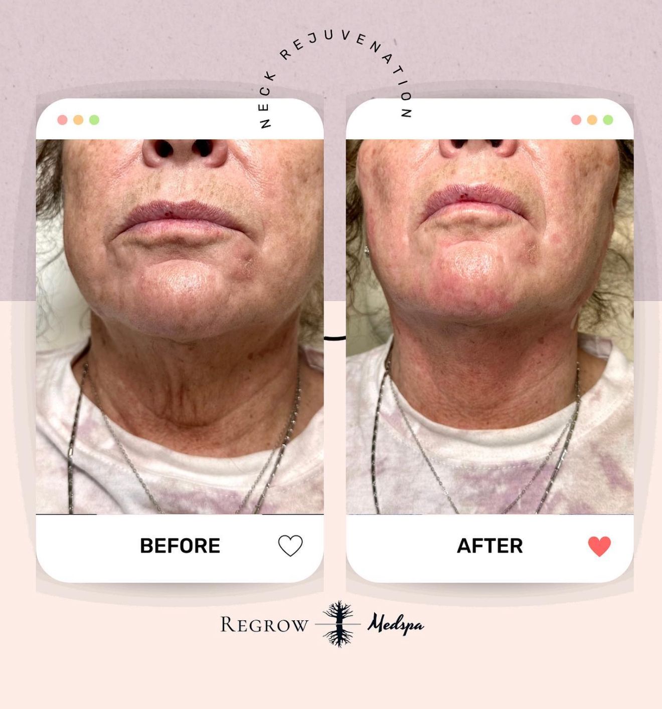 Before and after photos show neck rejuvenation on a woman; reduced wrinkles after treatment.