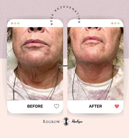 Before and after photos show neck rejuvenation on a woman; reduced wrinkles after treatment.