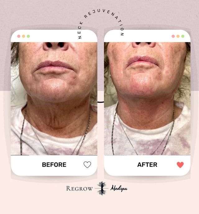 Before and after photos show neck rejuvenation on a woman; reduced wrinkles after treatment.