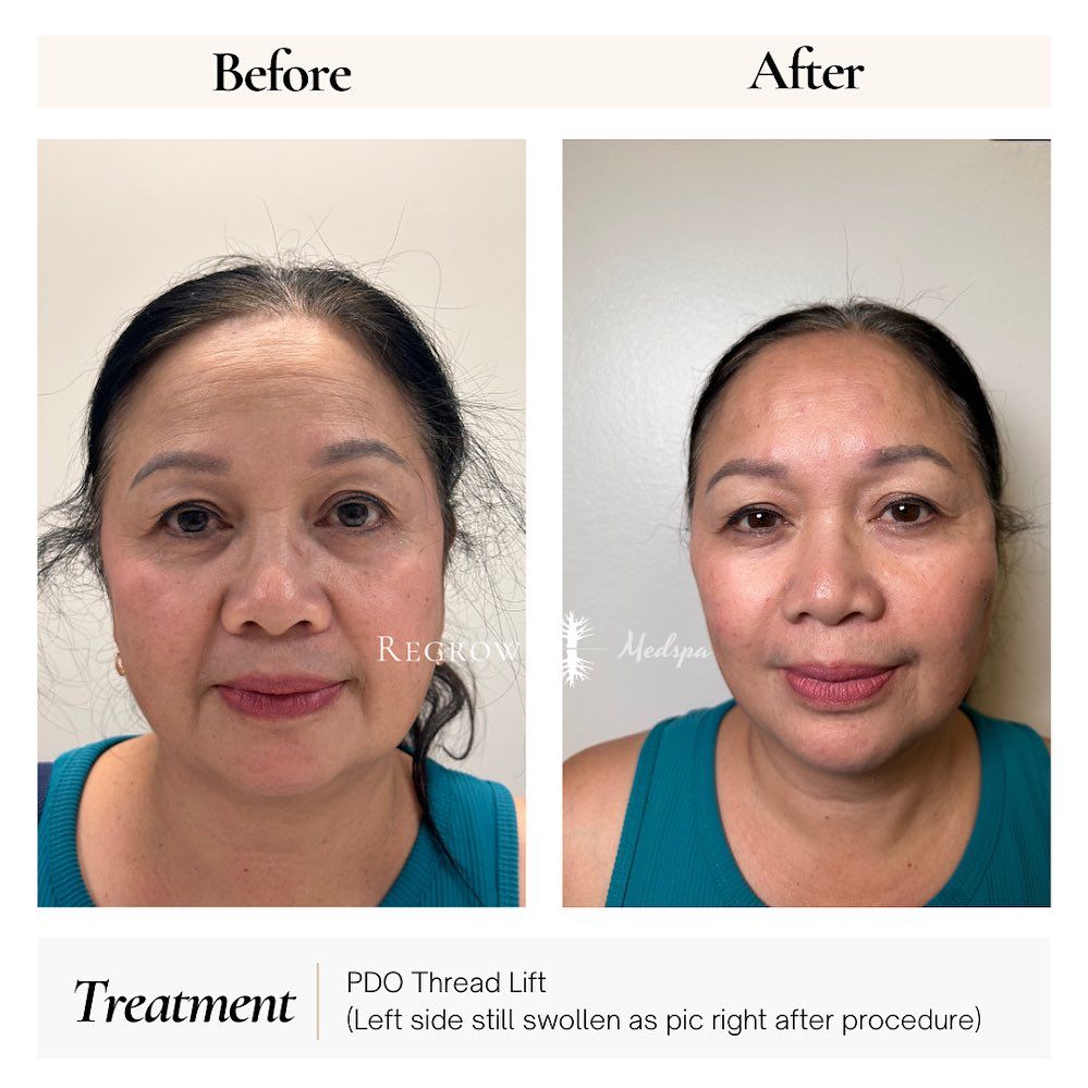 Before and after photos of a woman's face, showing the results of a PDO thread lift.