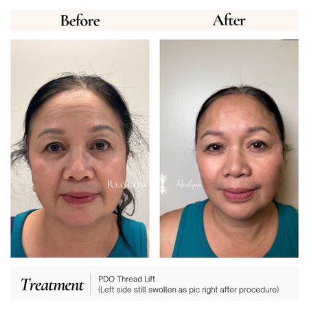 Before and after photos of a woman's face, showing the results of a PDO thread lift.
