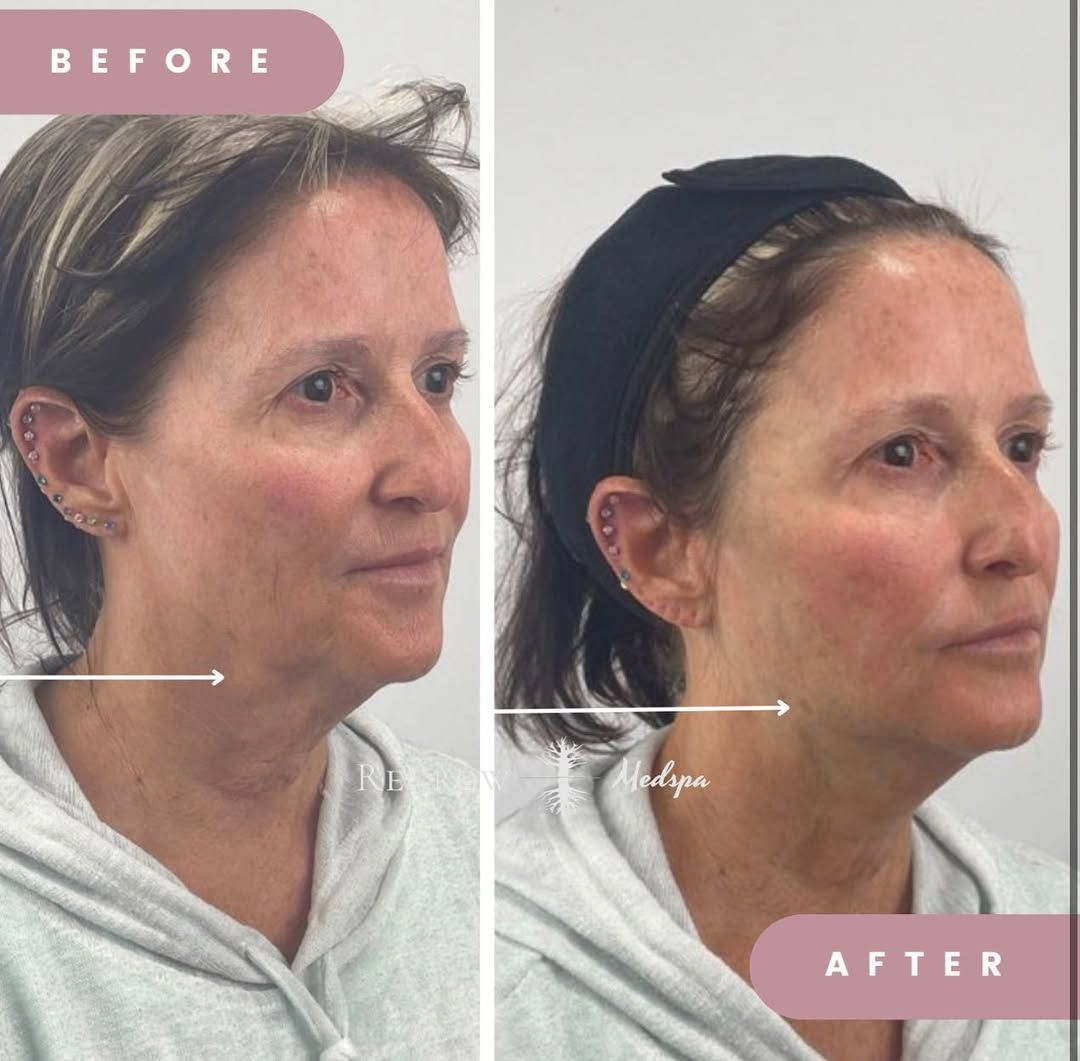 Before-and-after view of a woman's face after neck lift. Pink skin tone, younger appearance.