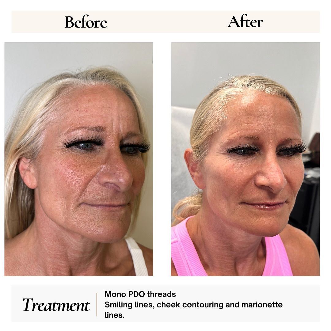 Side-by-side photos showing a woman's face before and after PDO thread treatment for wrinkles and contouring.