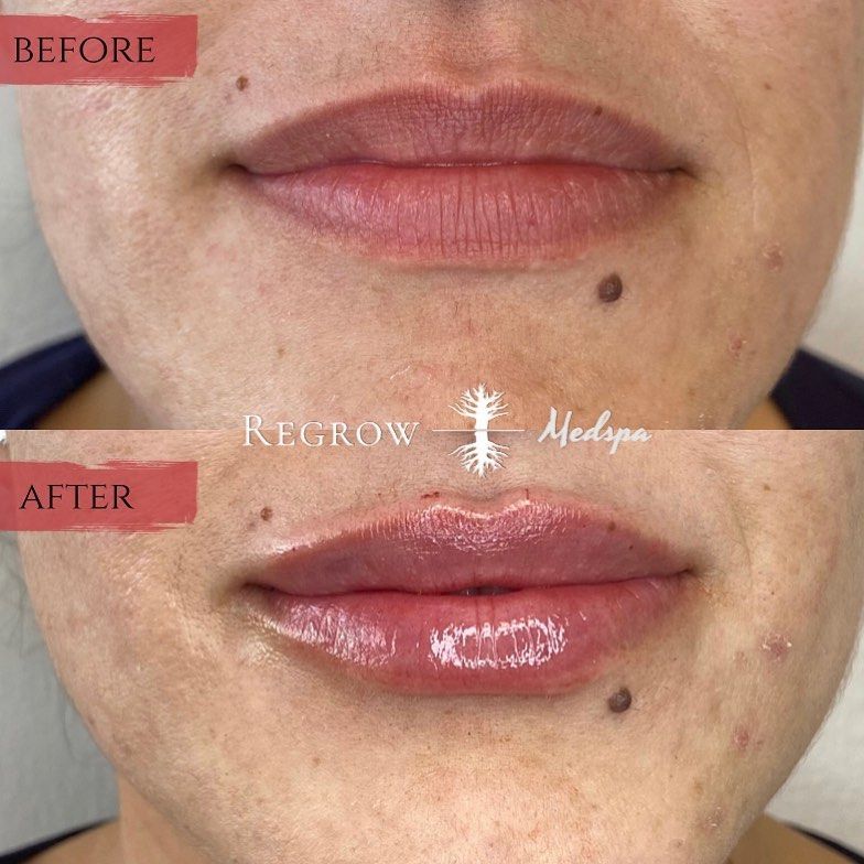 Before and after comparison of lip filler treatment; upper lips appear fuller and more defined in the 