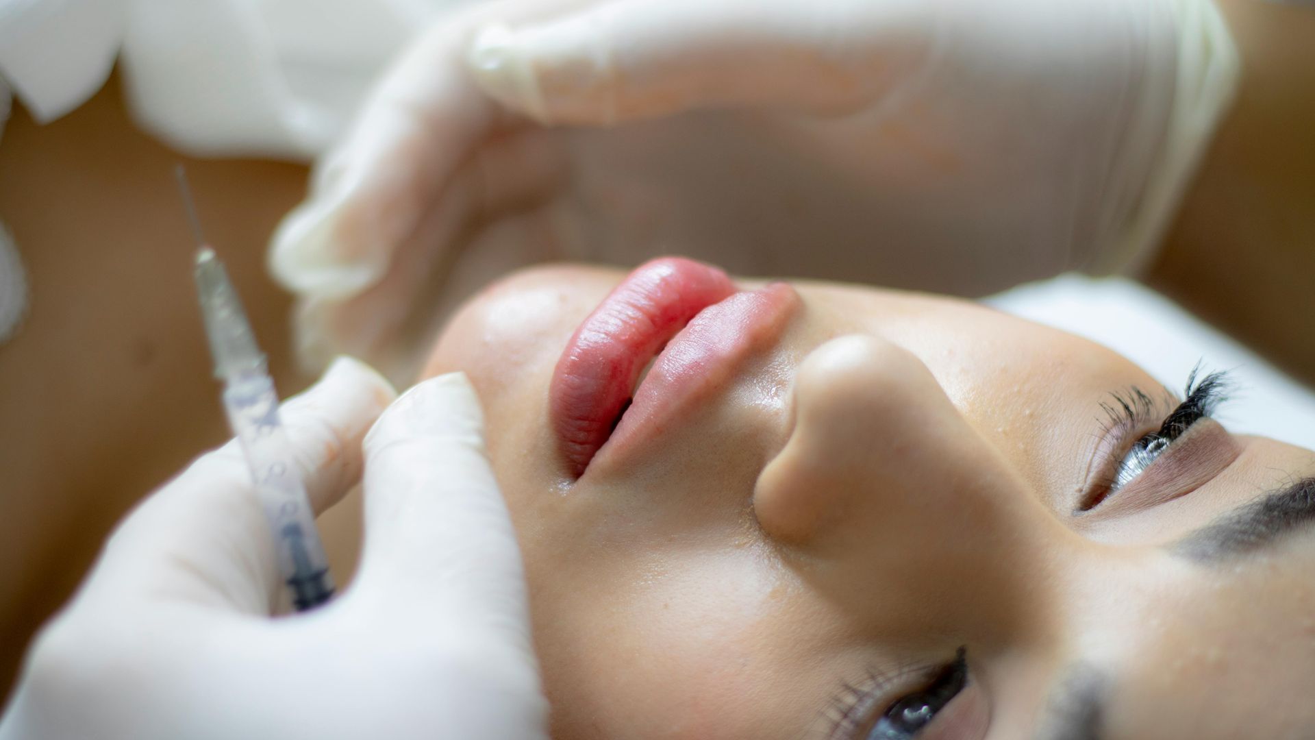 Person receiving lip filler injections. Hands in gloves holding syringe near lips.