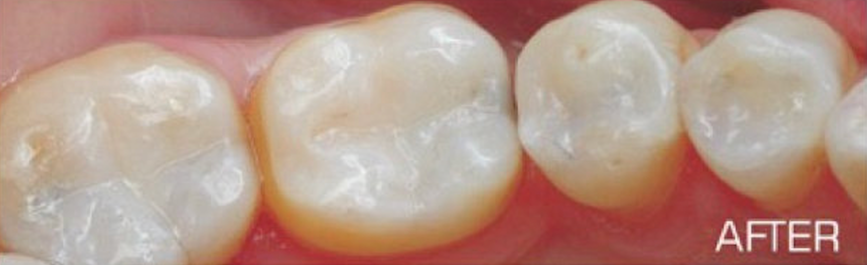 A close up of a person 's teeth with the caption after