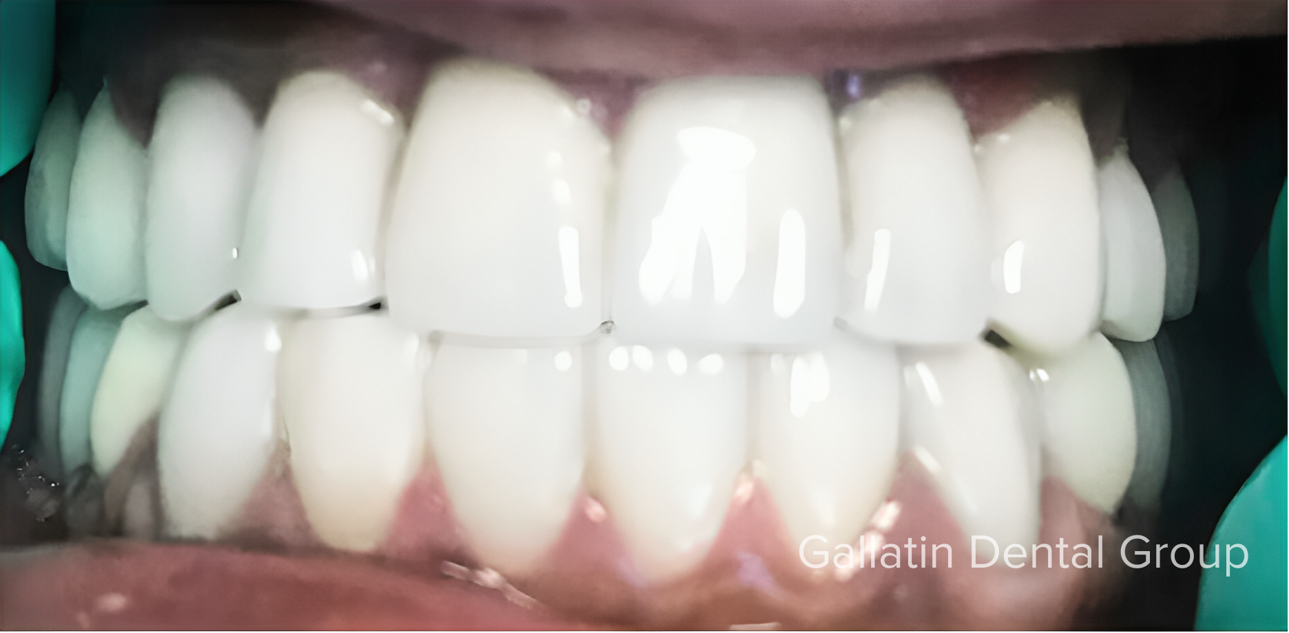 A close up of a person 's teeth with the words gelatin dental group on the bottom