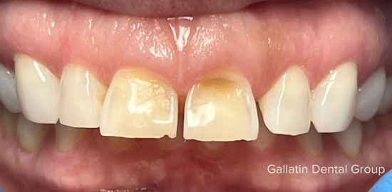 A close up of a person 's teeth with a broken tooth.