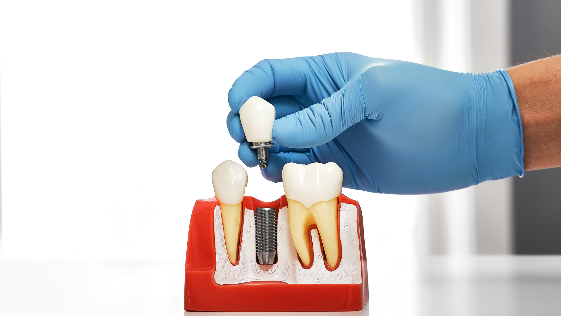 A dentist is putting a dental implant into a model of teeth.