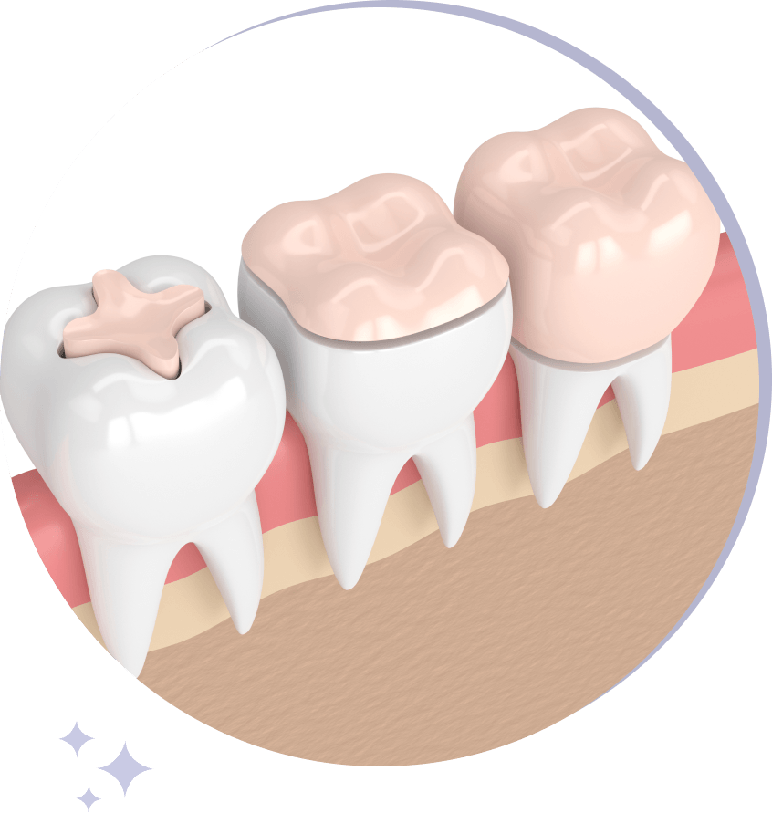 dental onlays and inlays, crowns