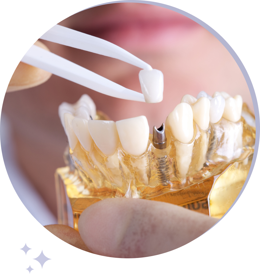 Dental Implants Aftercare Process Gallatin Dental Group