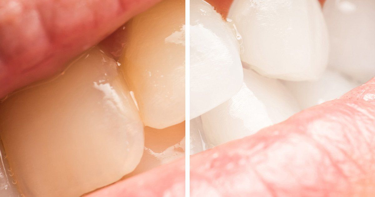 teeth whitening, cosmetic dentistry Methuen MA