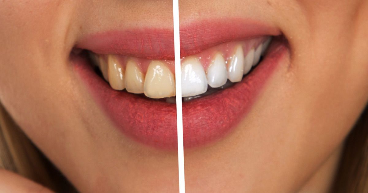 teeth whitening, dentist in Methuen MA